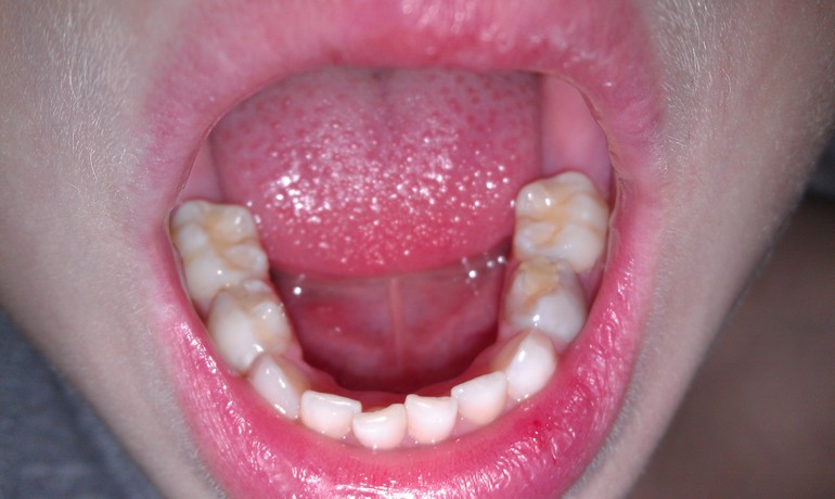 Темный зубик.