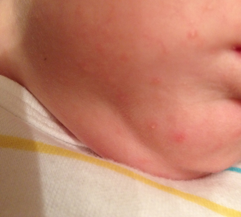 Непонятные высыпания