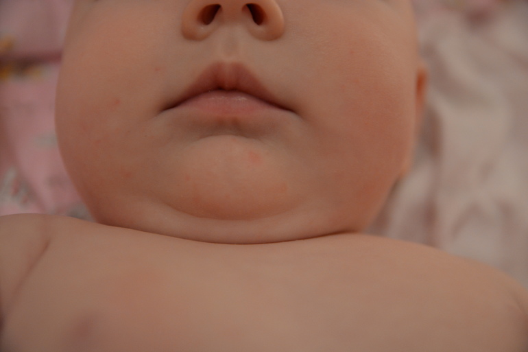 вопросы к аллергомамам