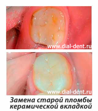 Замена старой пломбы керамической вкладкой