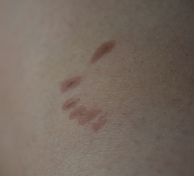 укусила собака