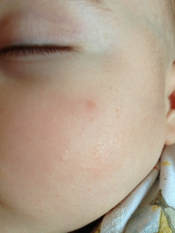 мелкая сыпь