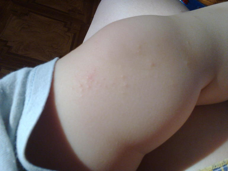 Что это за сыпь?