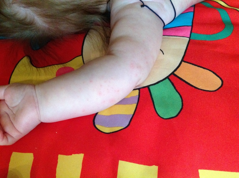 Аллергия после массажа