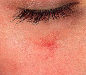 СОСУДИСТАЯ СЕТОЧКА НА КОЖЕ ЛИЦА... ПРИЯТНОГО МАЛО