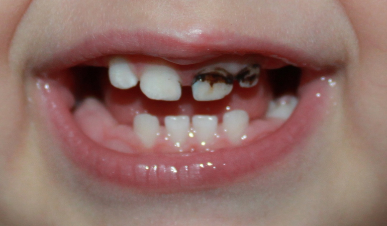 Серебренные зубы-как и когда их лечить?