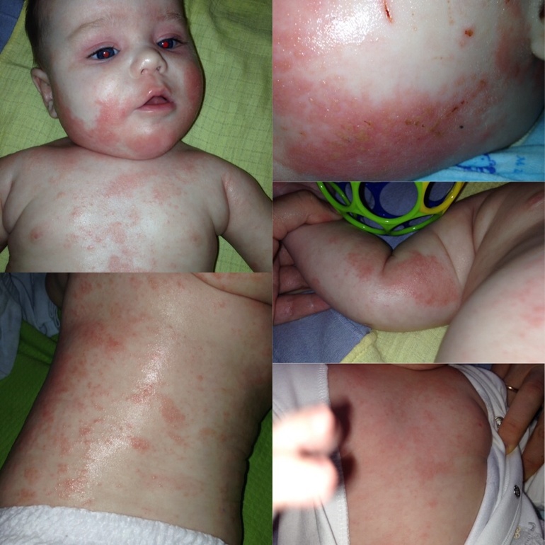 Неокейт день 11