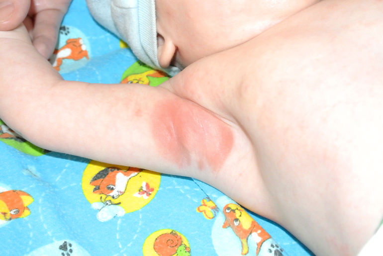 Аллергия ли это?