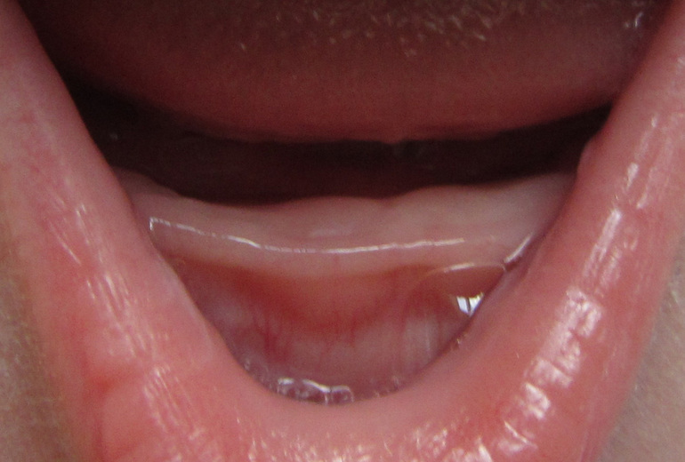 Первые молочные зубы у детей, признаки прорезывания зубов | Colgate