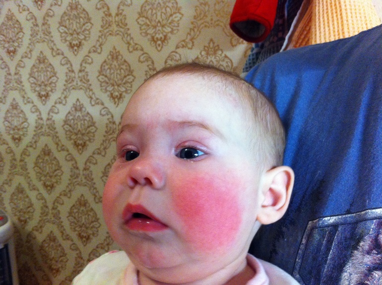 И снова о щеках....