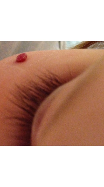 Капиллярная Гемангиома