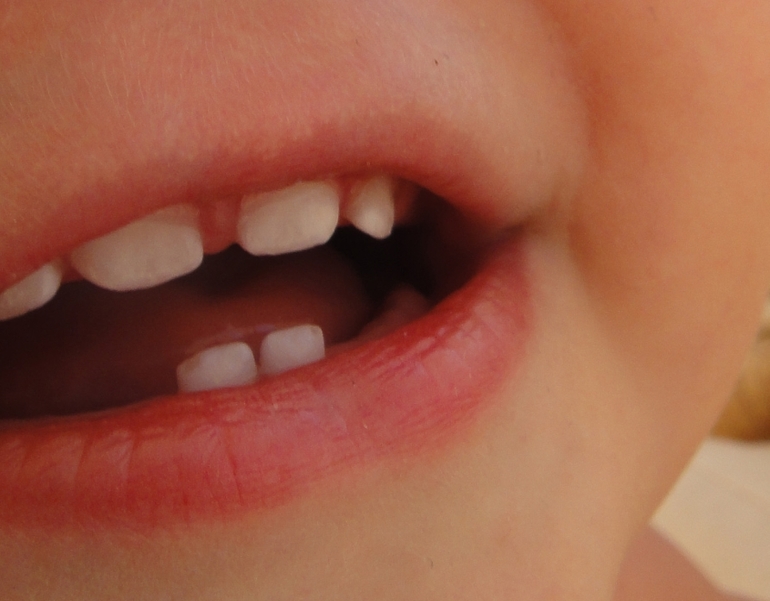 Отколы на двух резцах