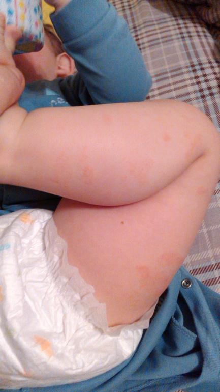 пятна на ножках