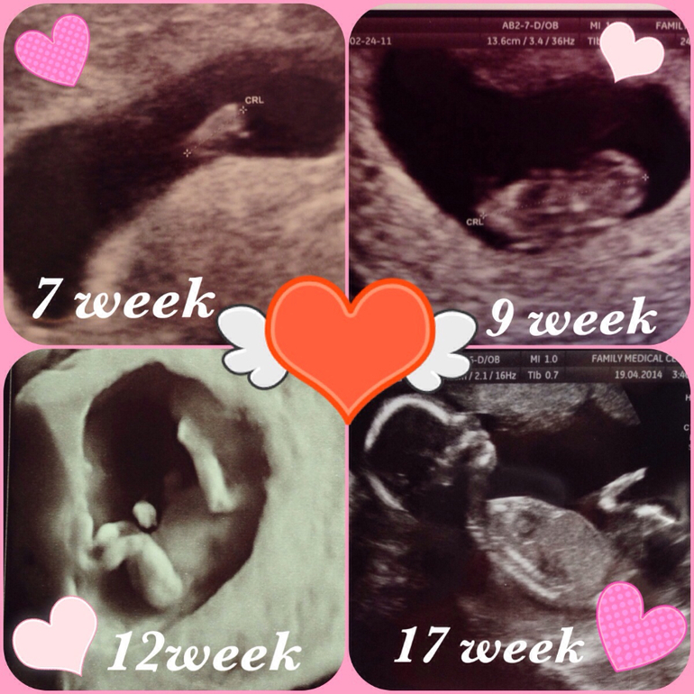 А у нас Девочка!!!17 неделя.