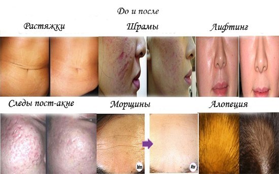 #Мезороллер с титановыми 540 иглами, для лица и тела. В наличии, в Тольятти