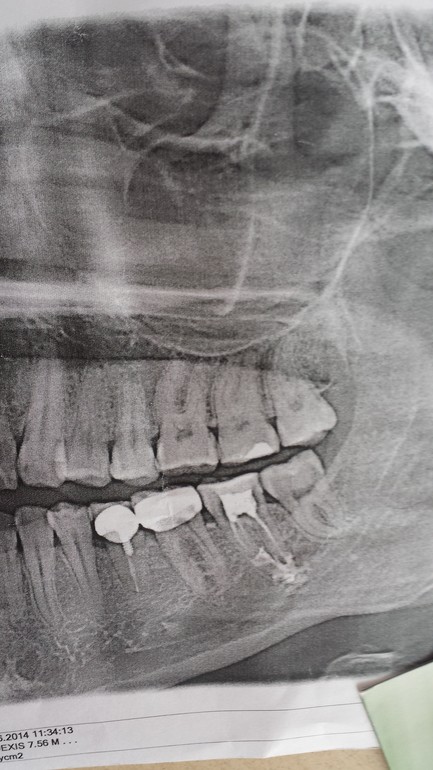 выход пломбировочного материала за верхушку корня