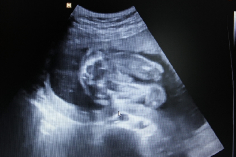 УРРРРАААААААААА!!!!!!!!!!! УЗИ в 21 неделю)))))))