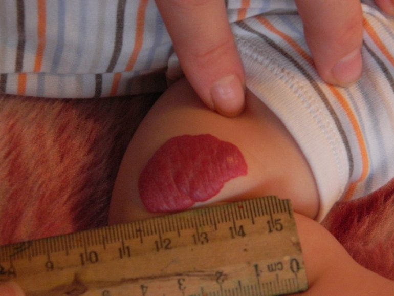 Гемангиомы. Кто наблюдает?