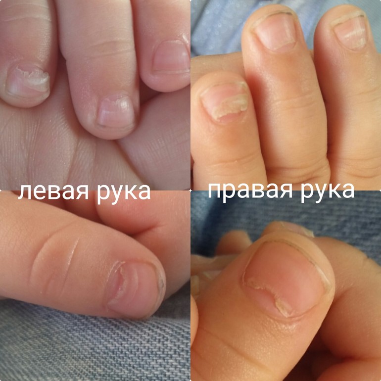 У ребенка слез ноготь причины У ребенка слез ноготь причины