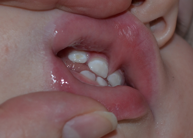 Темные пятна - кариес?