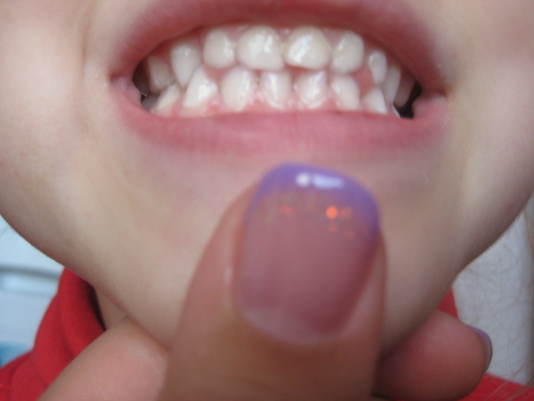 Кариес ? или что?