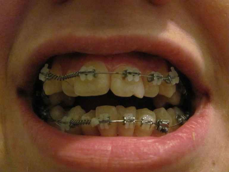 Брекета - продолжение 3