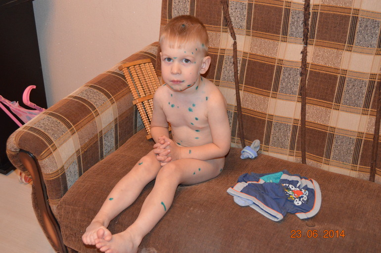 Наша ветрянка