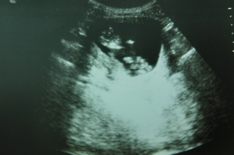 История моей Б, пишу на память для себя)))