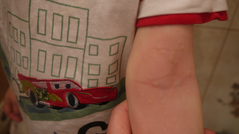 Здравствуй крапивница