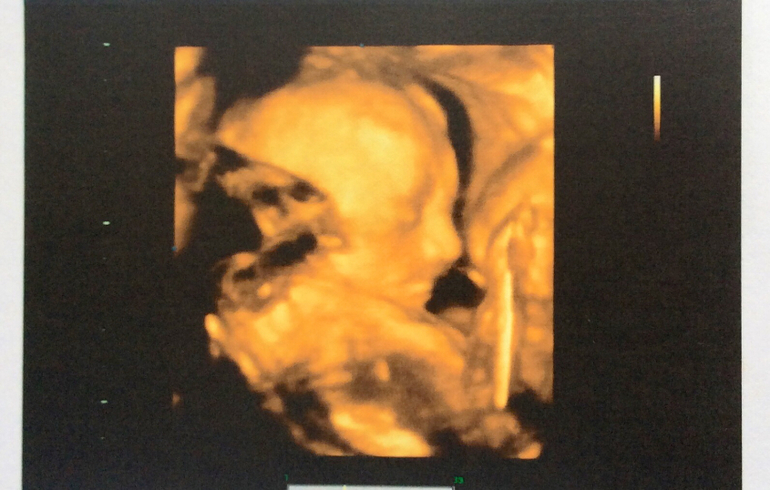 Внеплановое УЗИ 22-23 нед