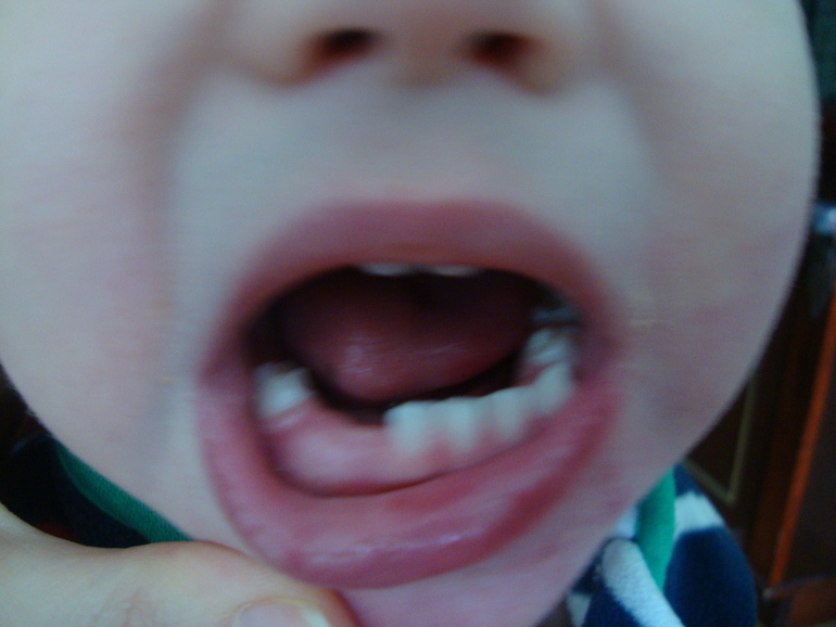 Сранное прорезывание