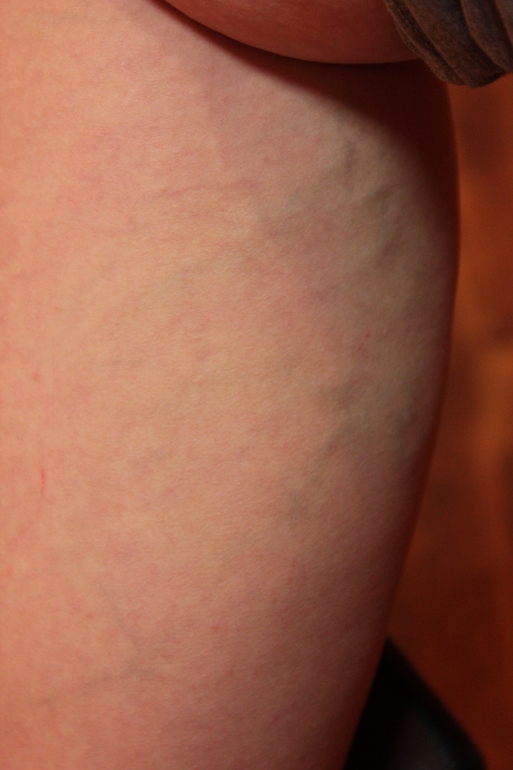 Варикоз и физические упражнения.