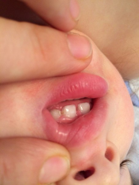 Проблемы с зубами, нам 1,8.