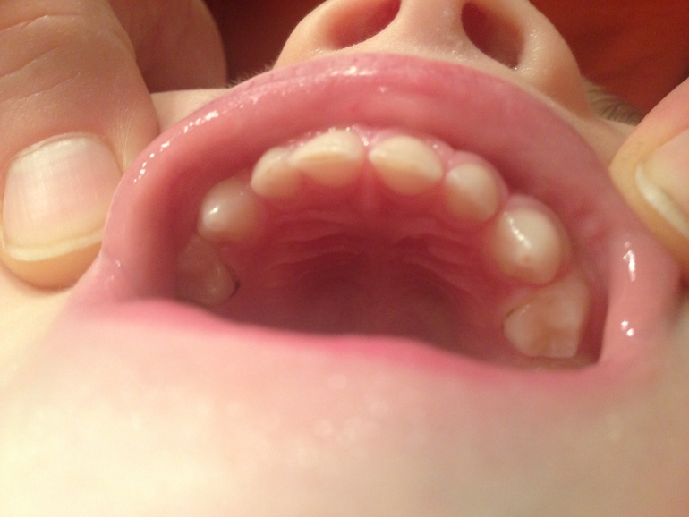 Это кариес?