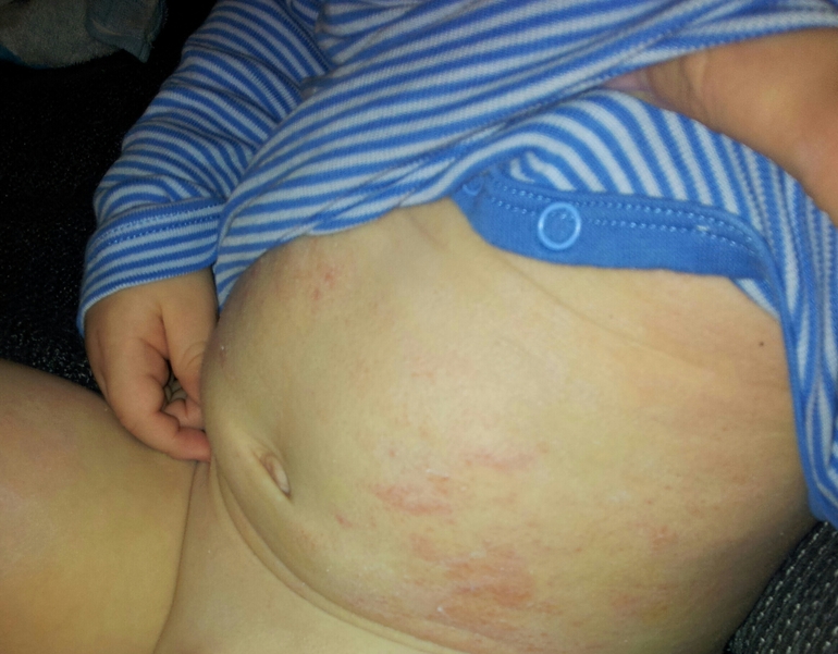 нейродермит? !?!