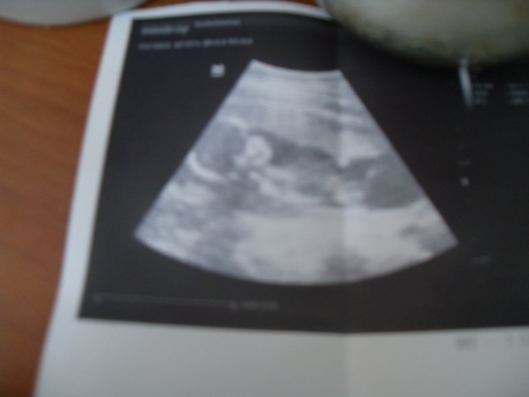 Помогите определить пол!(врач сказал большой процент девочка)так ли это?