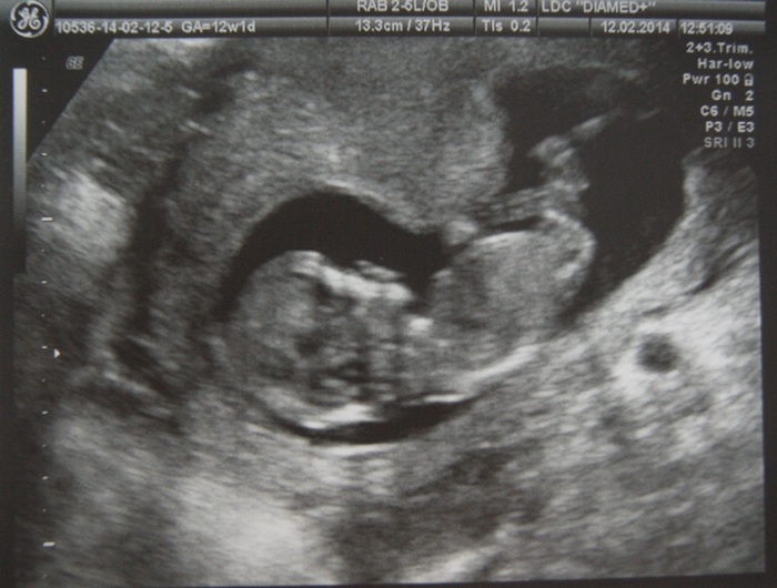 Вот и первый скрининг, а переживаний меньше не стало