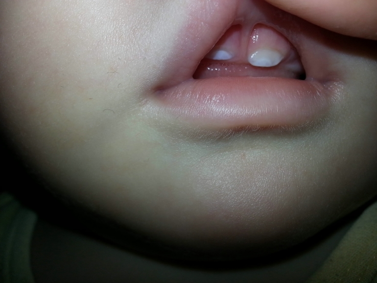 Гипоплазия Эмали?