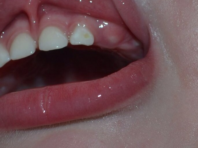 Образовалось пятно на зубе у ребенка.Скорее всего кариес.Как лечить?