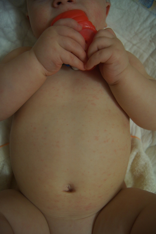 Аллергия или что-то другое?