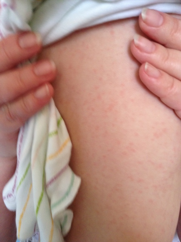 SOS помогите разобраться с генезисом сыпи