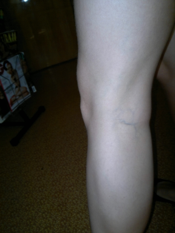 продолжение варикозной паранои.) фотки. ничего нового не увидите...