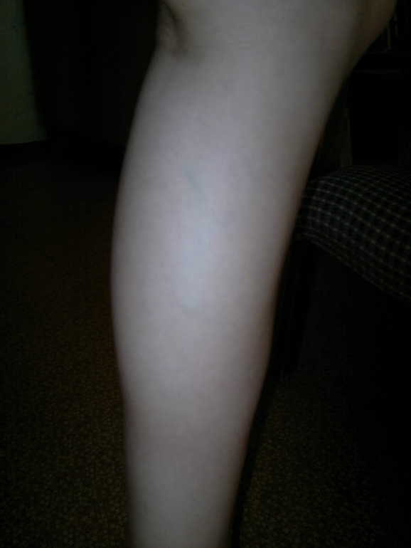 продолжение варикозной паранои.) фотки. ничего нового не увидите...