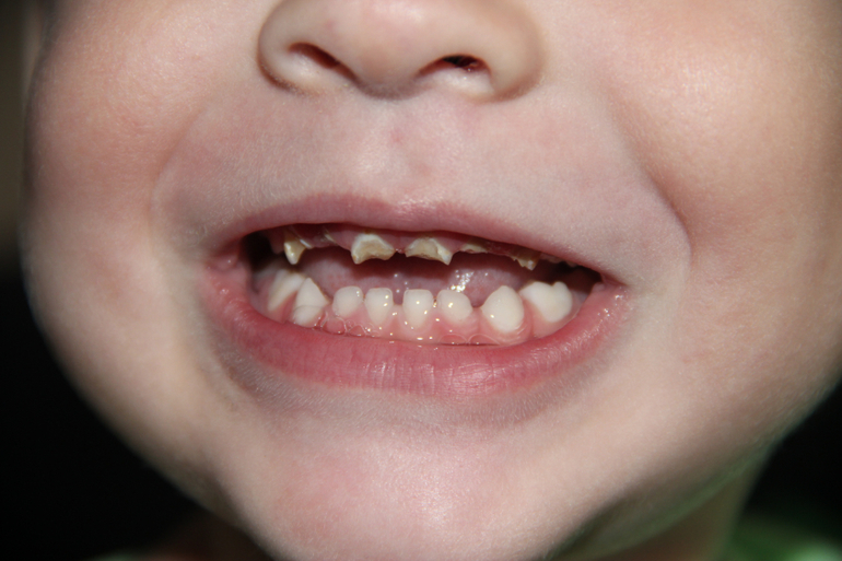 Наша беда с зубками