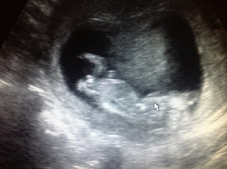 Прошли мы первый скрининг все хорошо!!!!! Ттттттттт!!!!