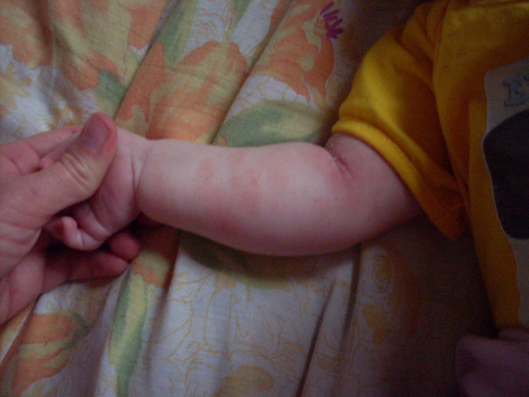 Краснота на коже