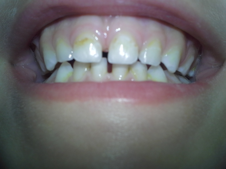 Лечение без общего наркоза