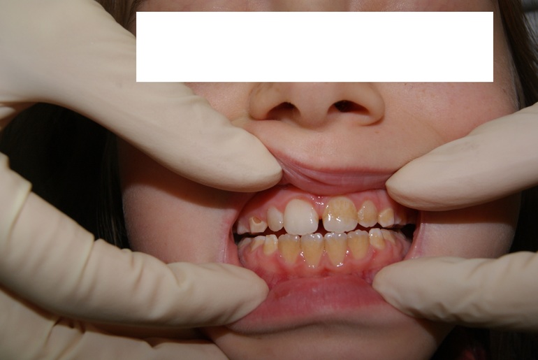 Налет на зубах