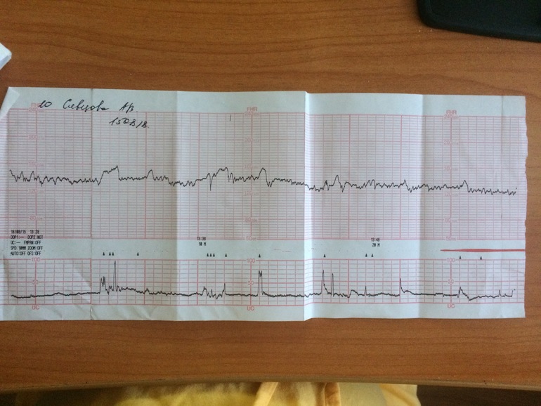 Схватки по ктг фото
