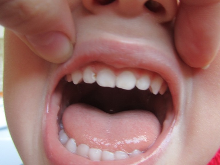 Как вылечить зубки?